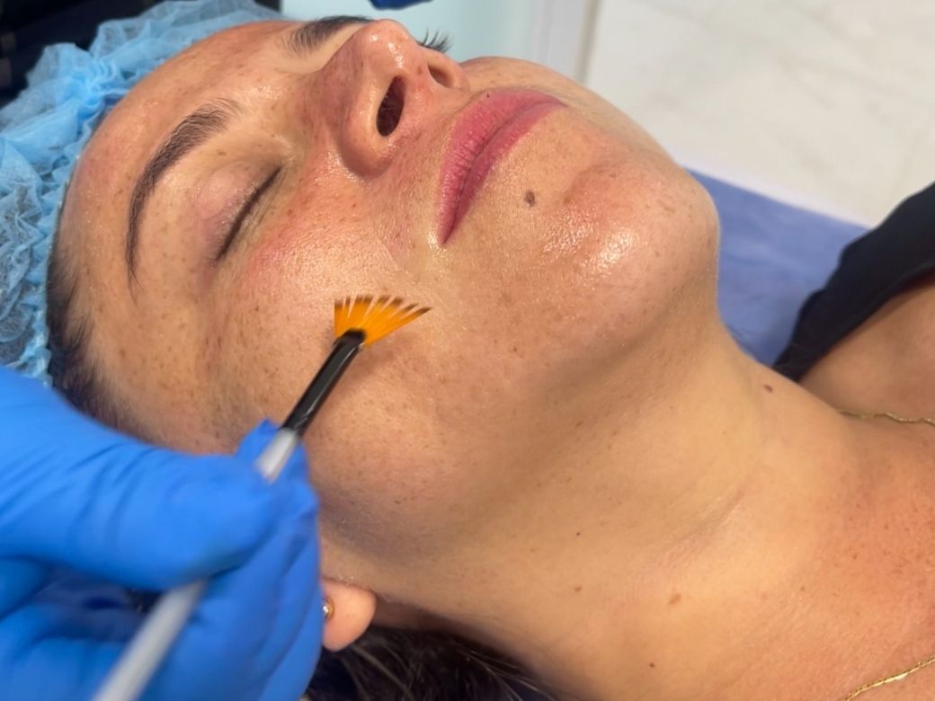 Peeling Facial