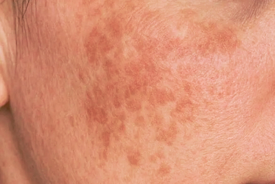 Manchas y Melasma