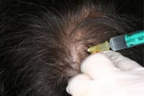 Mesoterapia