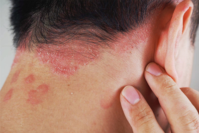 Psoriasis