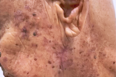Queratosis