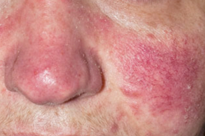 Rosácea y Dermatitis